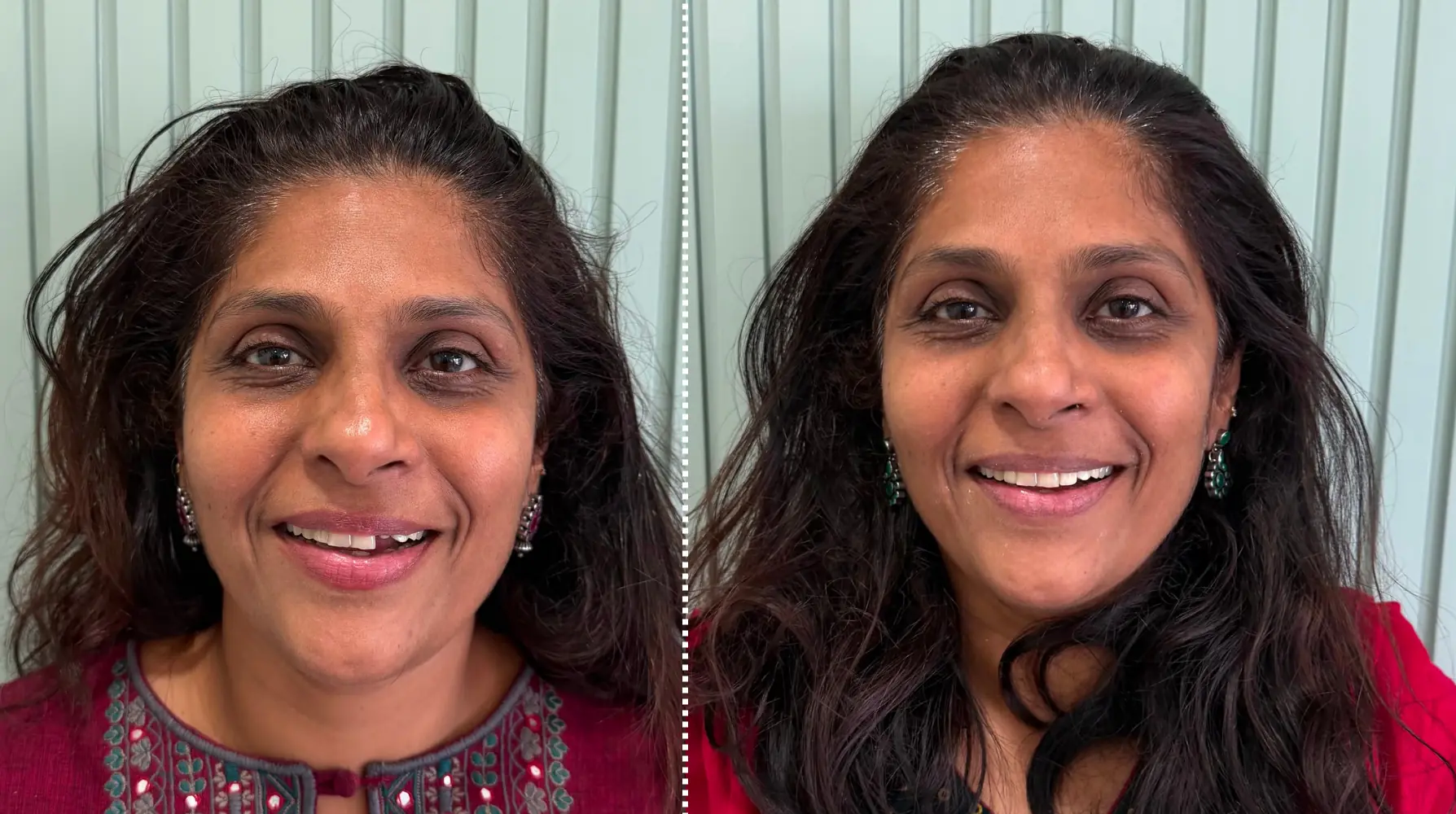 Veneers before and after — The Dental House, Chembur