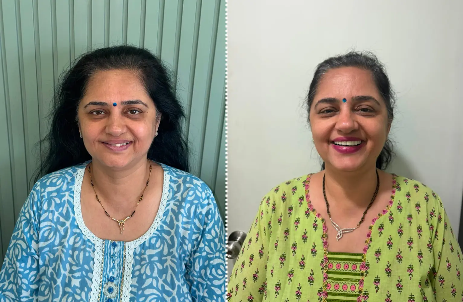 Dental Implant before and after — The Dental House, Chembur