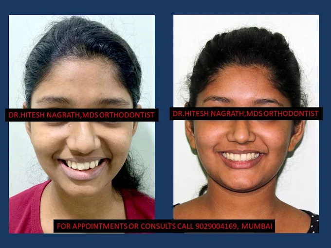 Clear Aligners before and after — The Dental House, Chembur