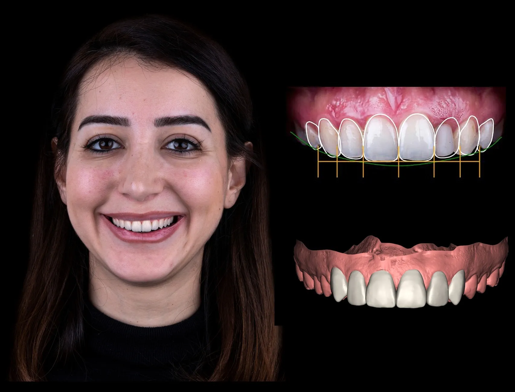 DTS Pro smile simulation