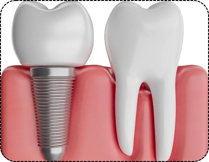 Dental Implants in Chembur