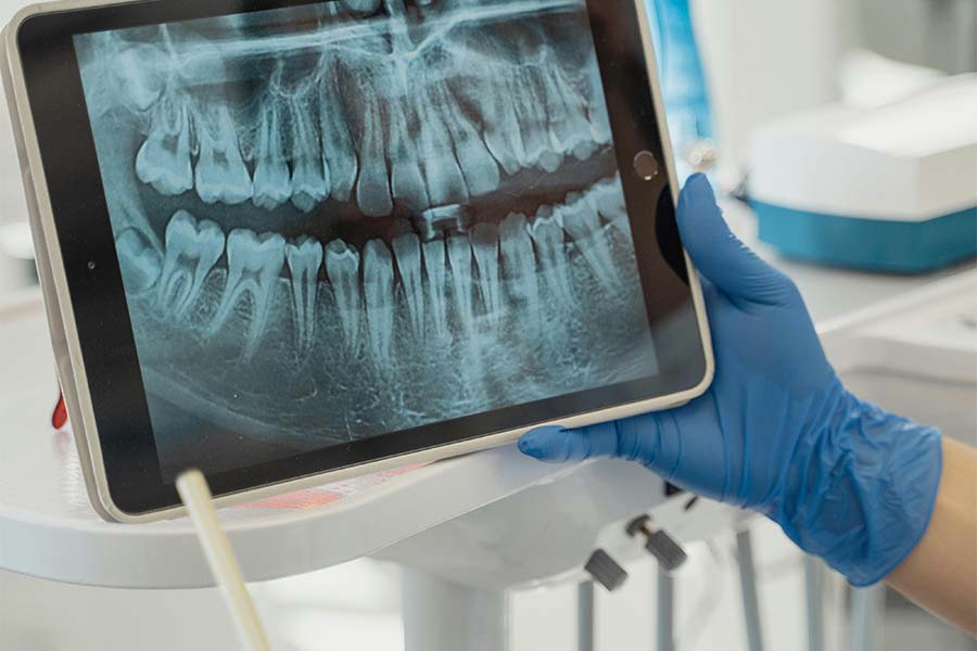Root Canal X-Ray picture of patient at The Dental House Mumbai